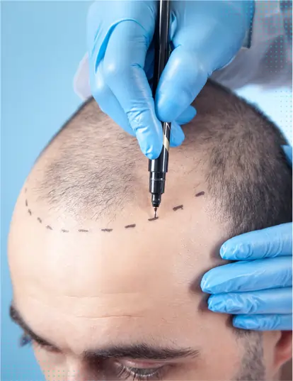 Activated Hair Transplantation